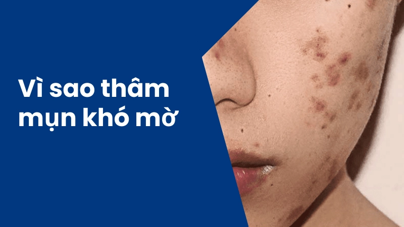 Nguyên nhân khiến thâm mụn lâu mờ